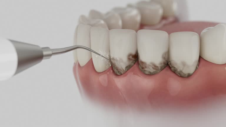 Trusted Wisdom Tooth Removal service in Clarinda, IA - Dentist Open Now